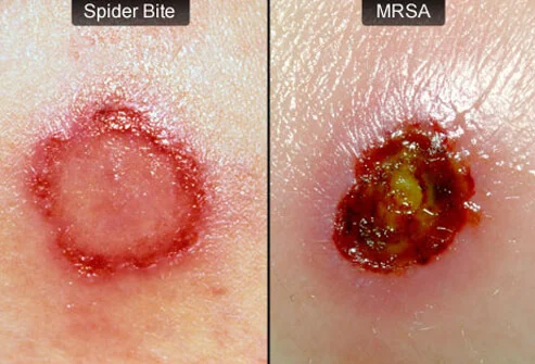 MRSA