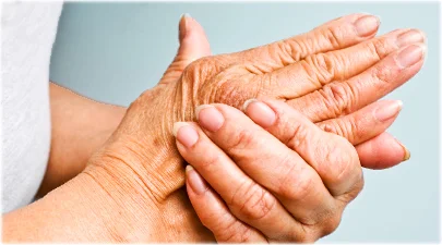arthritis