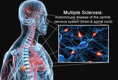 multiple sclerosis