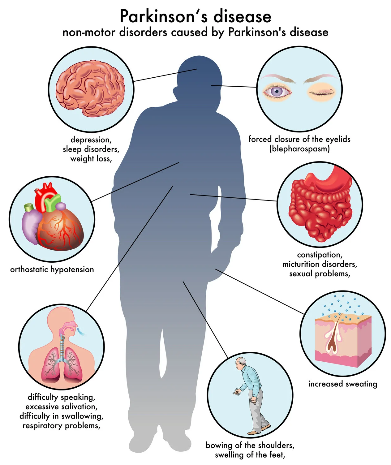 parkinsons disease